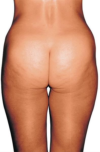 Cellulite nach Endermologie-Behandlung