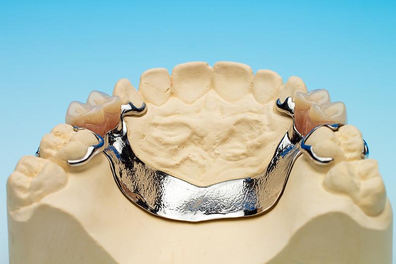 Gebiss Gipsabdruck mit Metall-Zahnbrücke